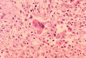 measles pneumonia